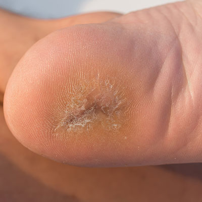 Skin Conditions Ottawa Foot Clinic