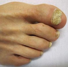 Foot Clinic - Thick Nails