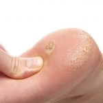 How are Corns and Calluses treated?