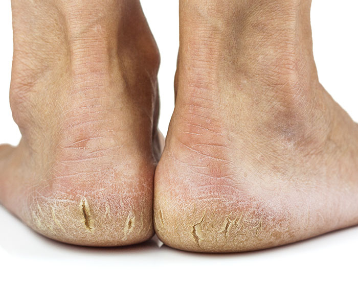 Get Rid of Dry or Cracked Heels  North Florida Foot & Ankle Center