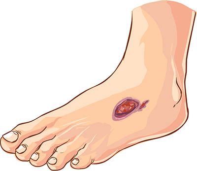 diabetic-wound-care