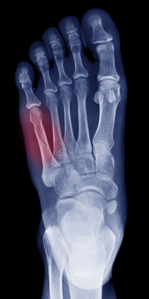 top of foot hairline fracture