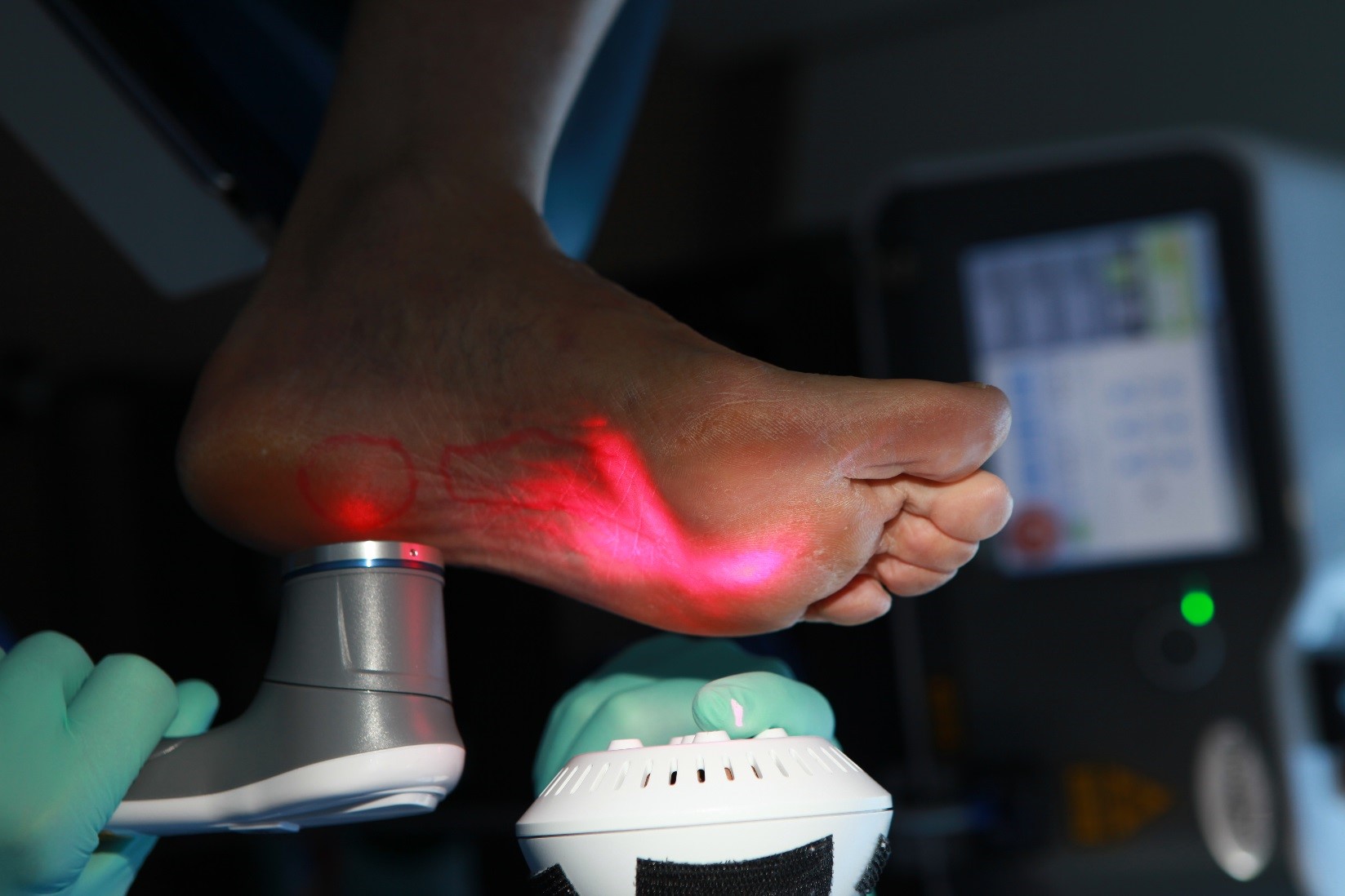 laser touch one for plantar fasciitis
