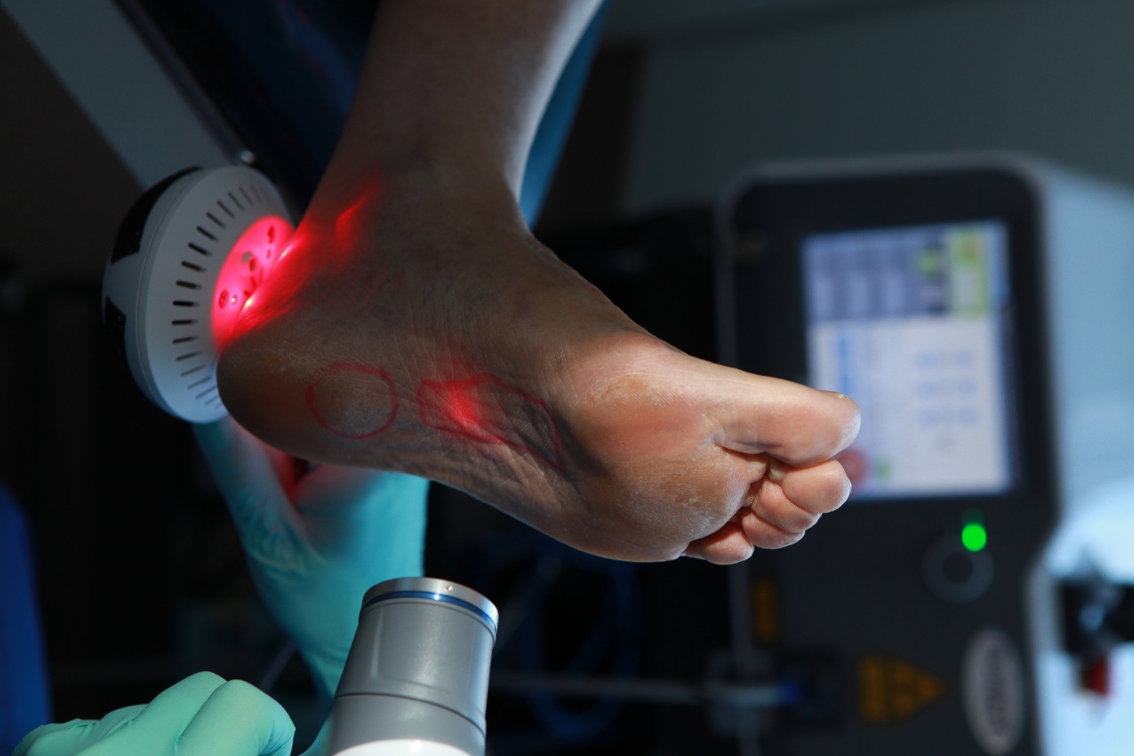 laser-pain-therapy-ottawa-foot-clinic