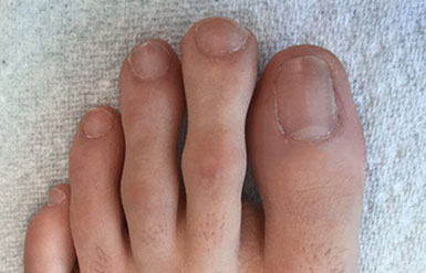 ingrown toenail removal before and after