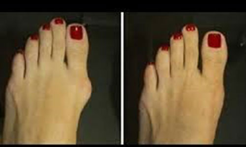 big toe bone spur treatment