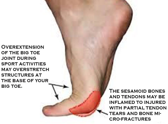  DIAGRAM Diagram Of Big Toe Pain MYDIAGRAM ONLINE