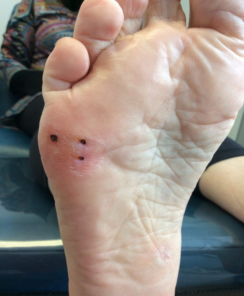 wart inside foot