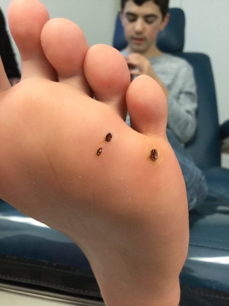 Plantar Warts Ottawa Foot Clinic